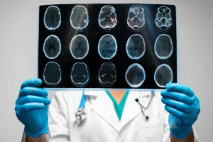 What’s The Difference Between Acquired and Traumatic Brain Injury in South Carolina?